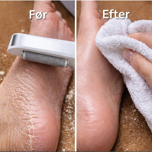 Se forskellen før og efter behandling med PediGlow™ fodfil