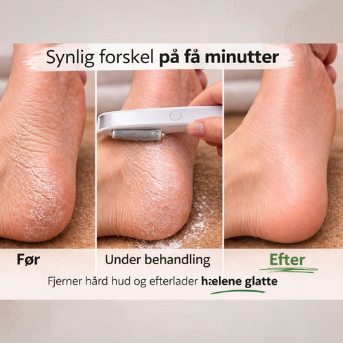 Resultat af PediGlow™ behandling af tør og hård hud