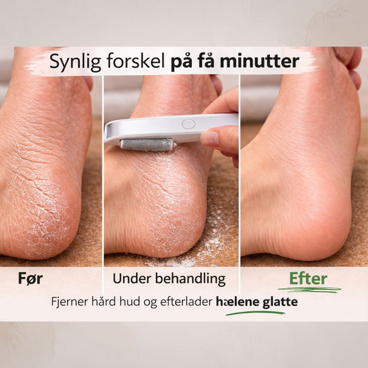 Resultat af PediGlow™ behandling af tør og hård hud